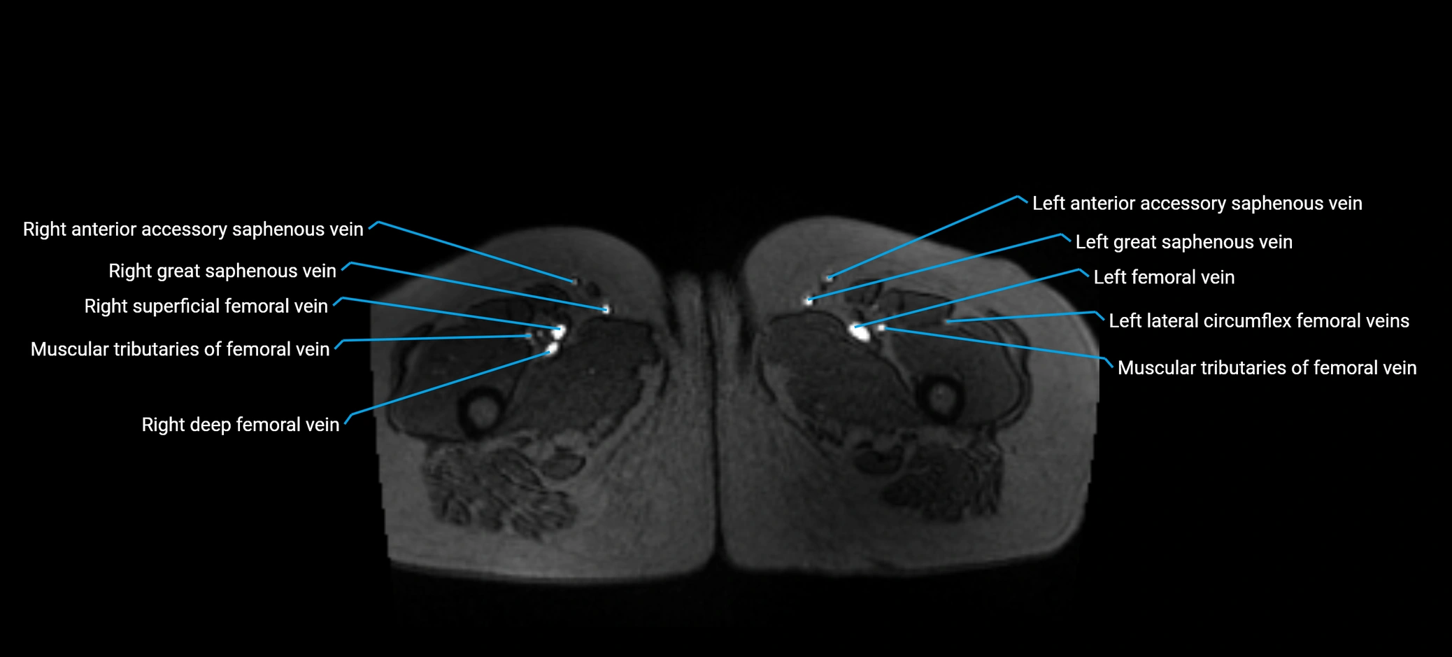 MRV abdomen pelvis & lower limb axial cross sectional anatomy labelled MRI image 215 (1).webp